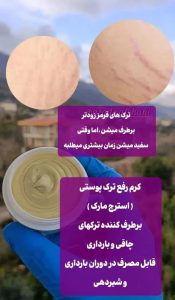 کرم رفع ترک های پوستی ( استرچ مارک)